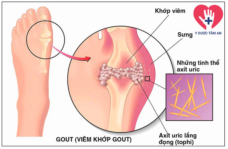 Nguyên nhân hình thành nên bệnh Gout